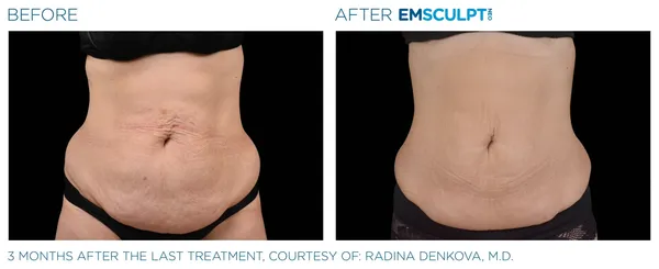 a woman's belly before and after treatment