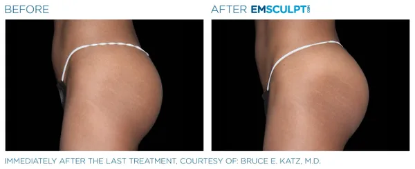 a comparison of a woman's buttocks - 7rs=w_600,cg_true,m