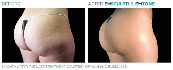 a comparison of a woman's buttocks - 8rs=w_600,cg_true,m