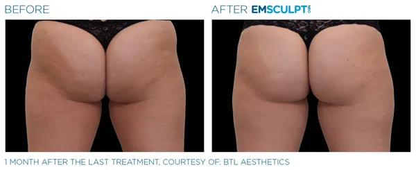 a woman's buttocks before and after - 9rs=w_600,cg_true,m