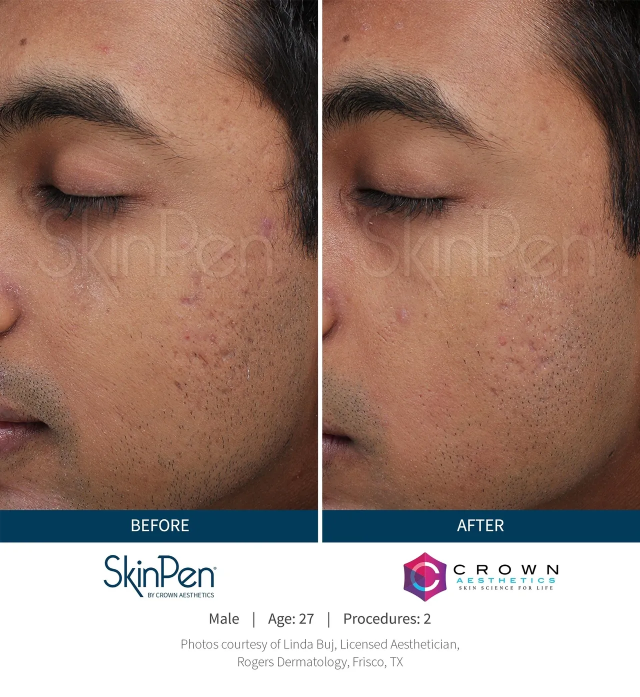 a man's face with his eyes closed - before after microneedling procedures2