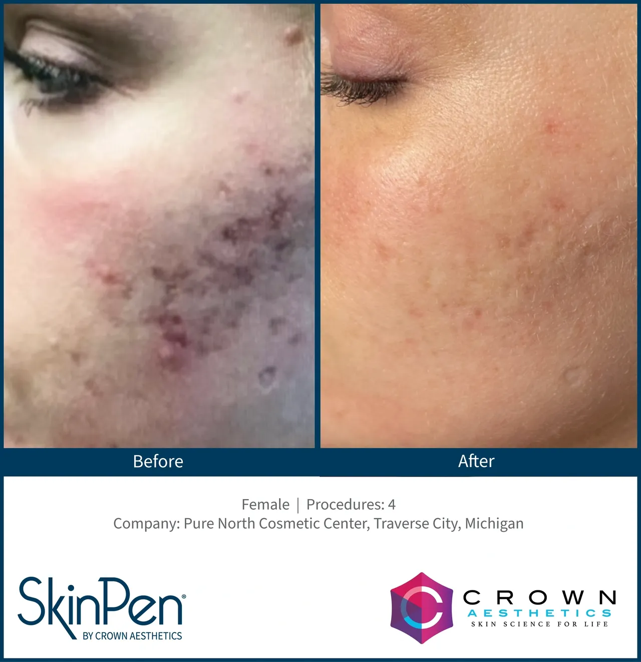 a woman's face with a before and after treatment - before after microneedling procedures4 michigan
