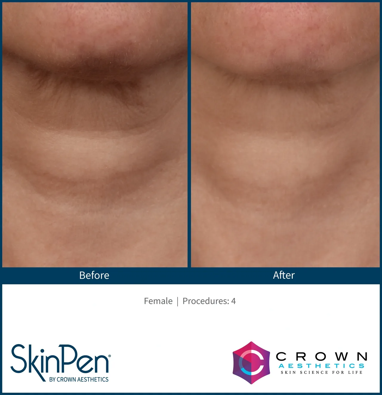 a collage of skincare procedures - before after microneedling procedures4