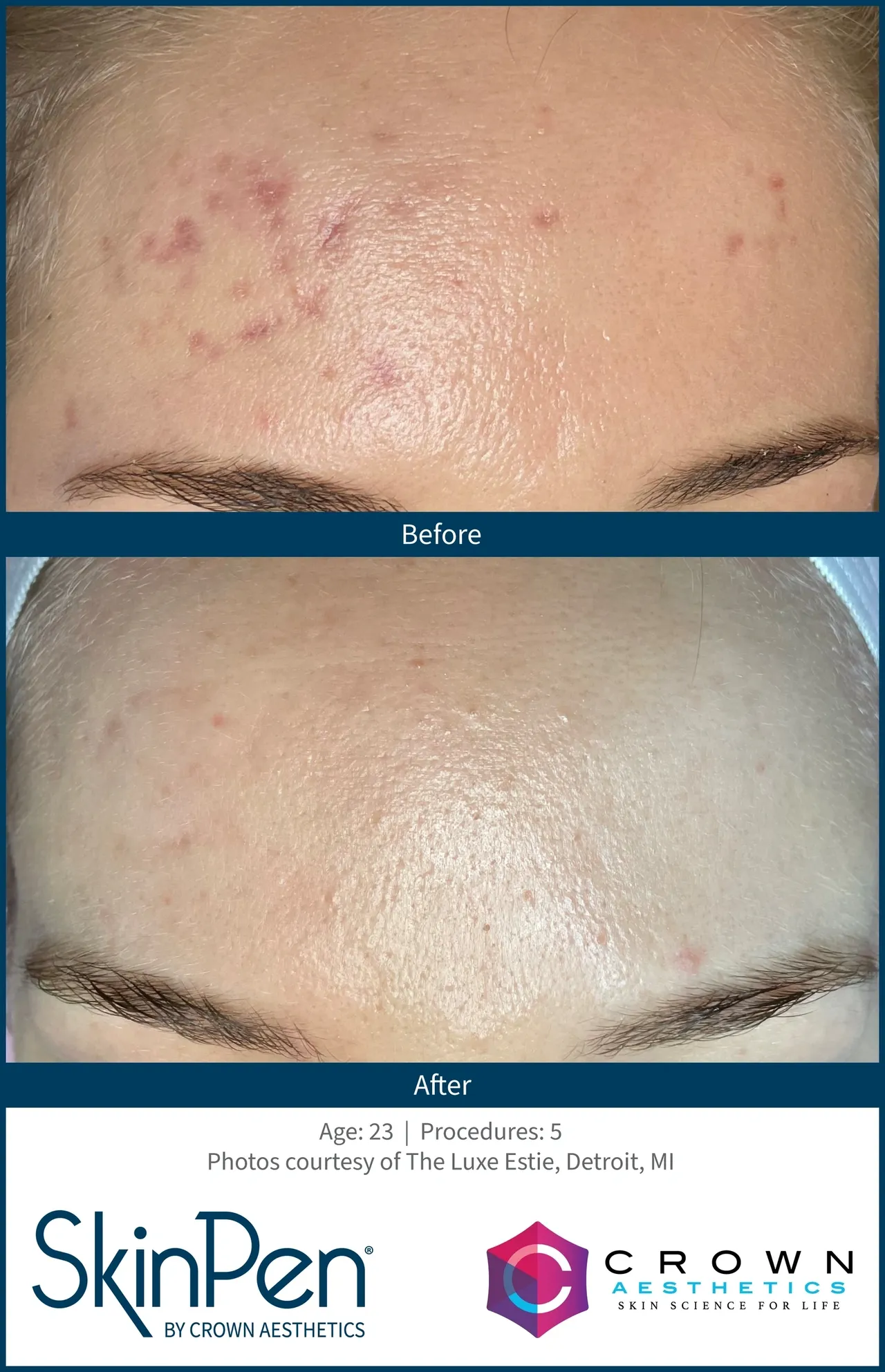 a close up of a person's face - before after microneedling procedures5