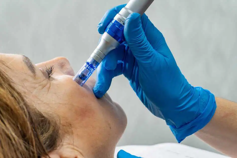 SkinPen Microneedling Treatments In Olympia, WA by Rejuvenate Olympia Center